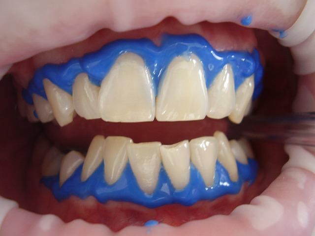 Comparing Laser Teeth Whitening to Other Whitening Methods
